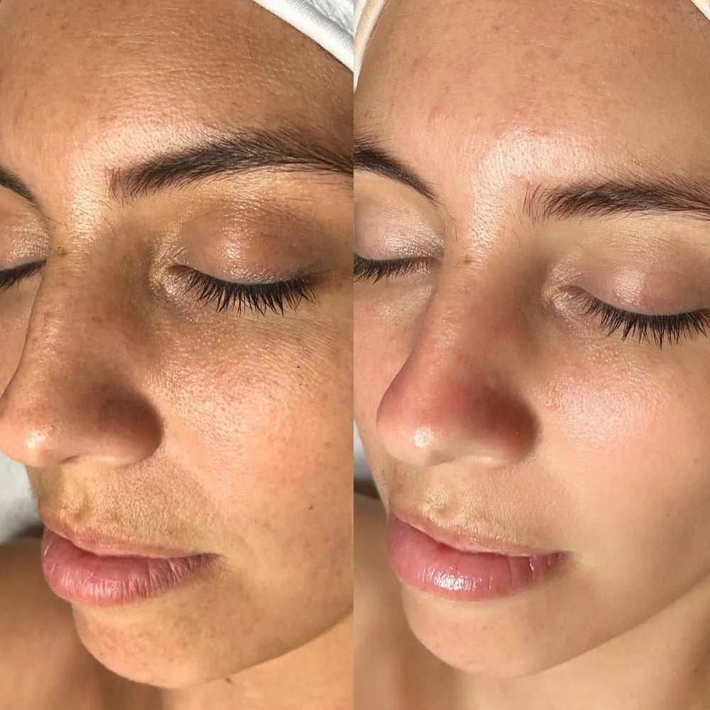 FACIAL